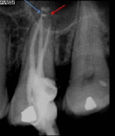 Endo26 20120809 114720 c5a4ai - Eugenol