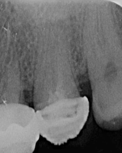 Endo 15  1  preop vuyysh - Eugenol