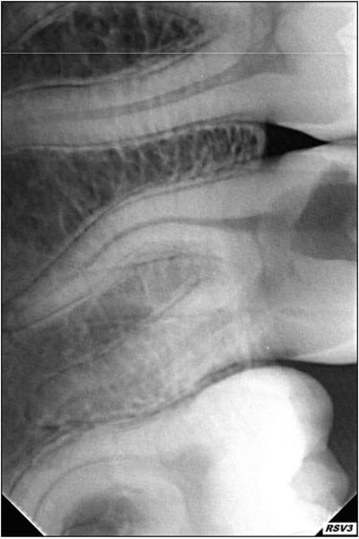 Endo 17  1  preop n6m5ub - Eugenol