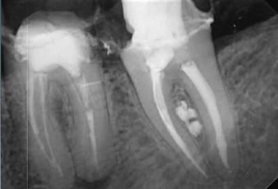 Endo 31  3  postop maybe crack or fracture e9js3k - Eugenol