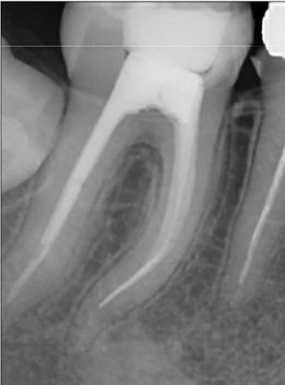 Endo 4  1  lime cass e preop ewbdub - Eugenol