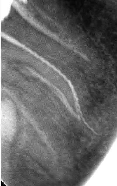 Endo 4  2  lime cass e lime pass e apsetj - Eugenol
