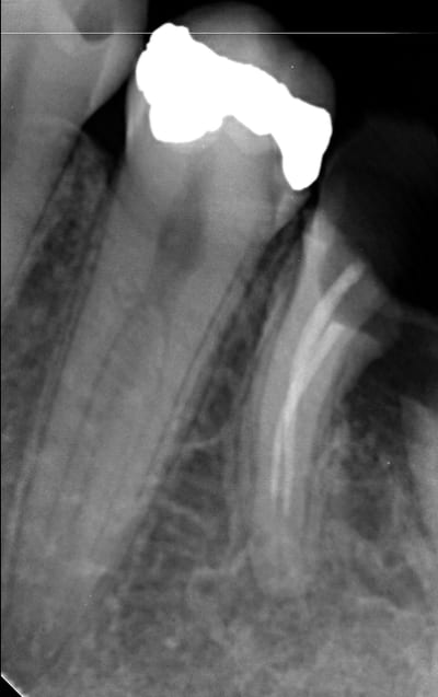 Endo 9  1  preop gepaja - Eugenol