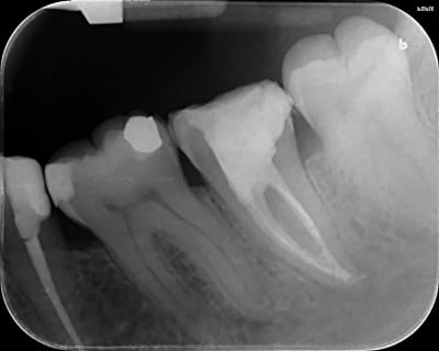 Endo pspix ijjg6o - Eugenol