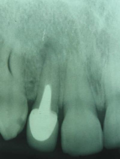 Endo ratée 3 pyaxwm - Eugenol