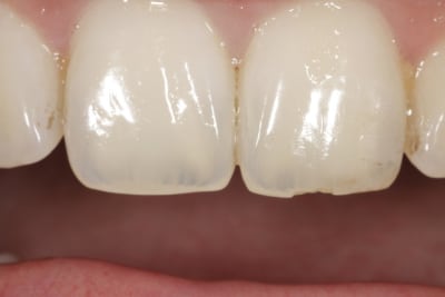 Essai photo dentaire 011 cj8hcs - Eugenol
