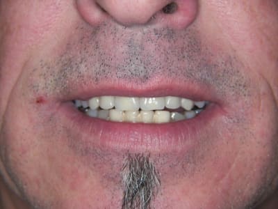 Essayage sourire rlc2su - Eugenol