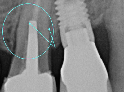 Fracture c4ivzf - Eugenol