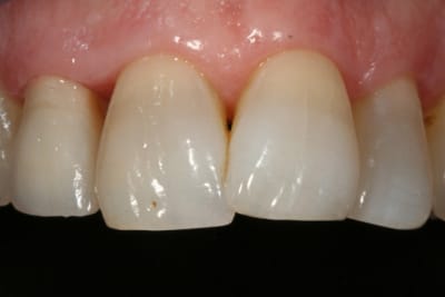 G apr s 4 dents plv8nk - Eugenol