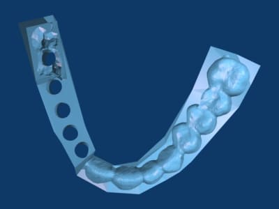 Gouttière stl avant impression 3d rendu blender exrrtz - Eugenol