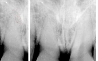Granulome post traumatique akxbxr - Eugenol