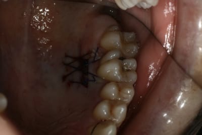 Greffe 006 heicmx - Eugenol