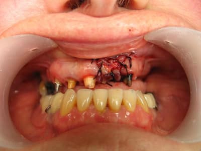 Greffe massacre ve4cqv - Eugenol