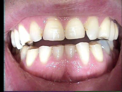 Grignote anspbx - Eugenol