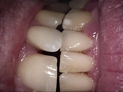 Guidage ant rieur 3 oaseit - Eugenol