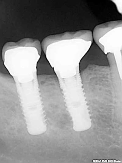 Implant 072008 kcs9ey - Eugenol