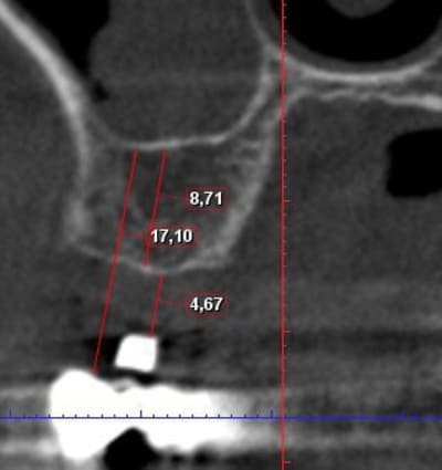 Implant 17 gkmdvi - Eugenol