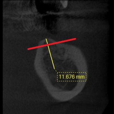 Implant 36 lhy2sh - Eugenol