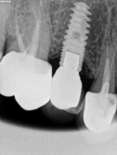 Implant d vds uvzurt - Eugenol