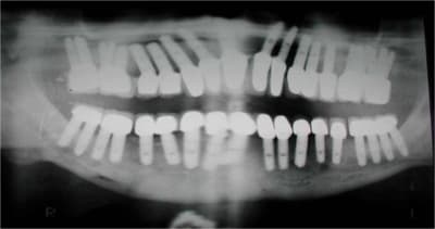 Implant  k och uk tyjlwf - Eugenol