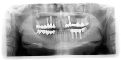 Implant dent aesp5i - Eugenol