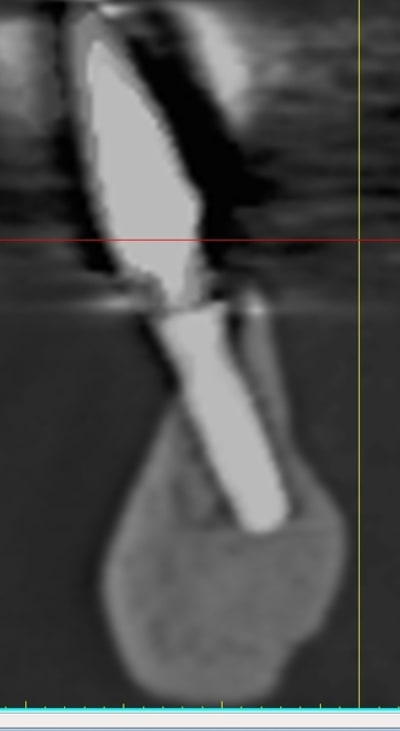 Implant inconnu 4 avpipn - Eugenol