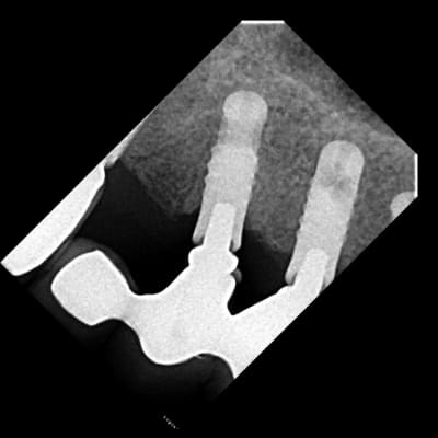 Implant inconnu jocecz - Eugenol