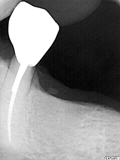 Implant xfdruh - Eugenol