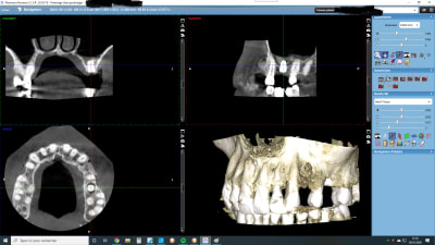 Implant xtw7e5 - Eugenol