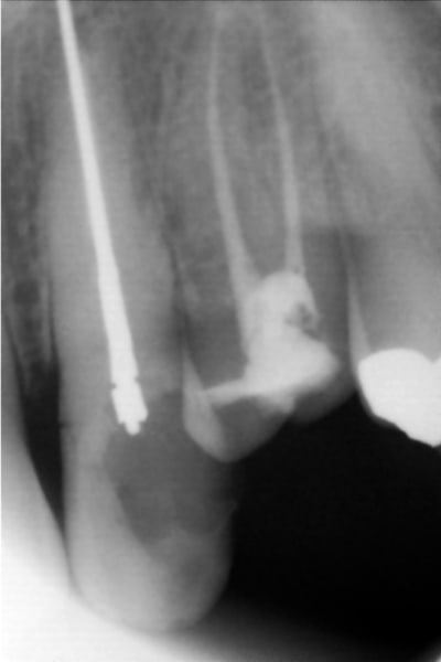 Implantoide ir74j5 - Eugenol