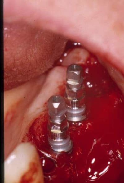 Implants cj4ewk - Eugenol