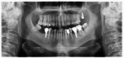 Implants tekka snj6ln - Eugenol