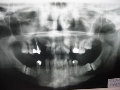 Incluses bis o72uls - Eugenol