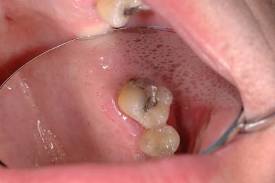 Initial ttirce - Eugenol