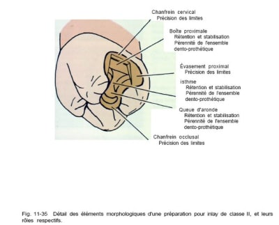 Inlay 2 y4pe14 - Eugenol