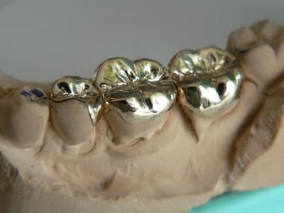 Inlays onlays oc9kcf - Eugenol