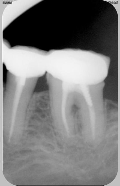 Interradiculaire 1 uvcttp - Eugenol