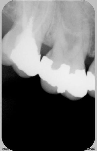 Interradiculaire 3 uajcag - Eugenol