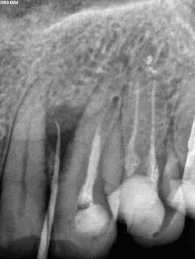 Kyste interradiculaire nuz8jl - Eugenol