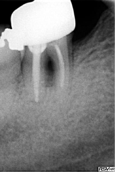 Lesion paro wwof8q - Eugenol