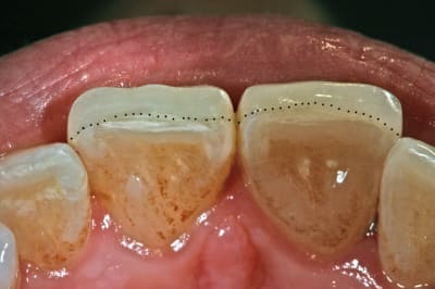 Limite u7rzve - Eugenol