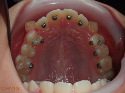 Lingual n7g2pv - Eugenol