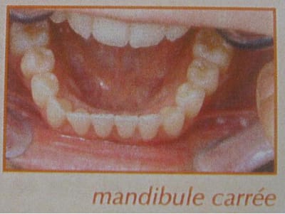 Mandibule carrée bcbhxg - Eugenol