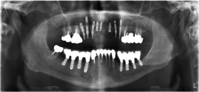 Mandibule cj3msl - Eugenol