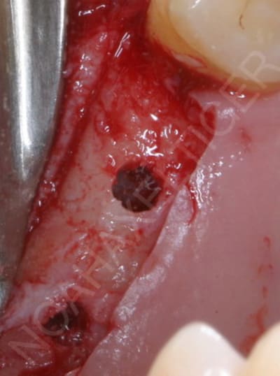 Membrane schneider intacte iiyf9z - Eugenol