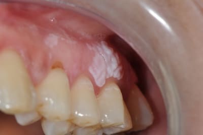 Miremont 004 ahecbw - Eugenol