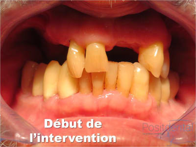 Mise en charge immédiate   implant tov  positdental 005 dfgpd6 - Eugenol