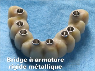 Mise en charge immédiate   implant tov  positdental 017 xhfzql - Eugenol