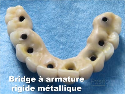 Mise en charge immédiate   implant tov  positdental 018 yefs4g - Eugenol