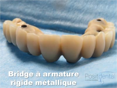 Mise en charge immédiate   implant tov  positdental 022 l0pqfc - Eugenol